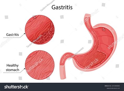 Gastritis Detailed Infographic In Comparison Royalty Free Stock Vector 2255984885