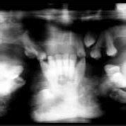 Orthopantomograph Of The Same Patient As In Figure 3 Revealing