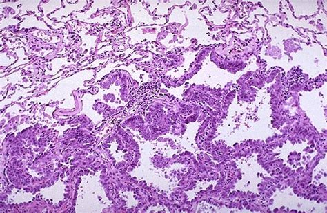 Lung Carcinoma Histology