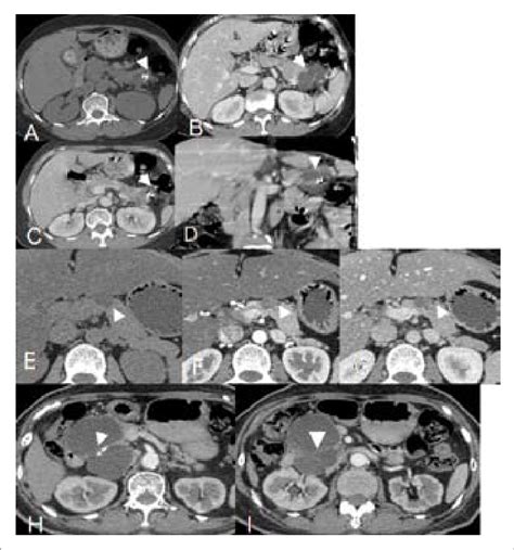 Serous Cystadenoma A D Polycystic Pattern A Axial Non Contrast Ct