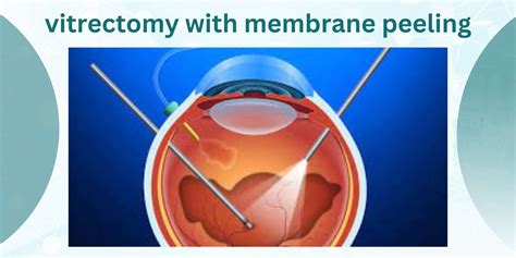 Vitrectomy Membrane Peeling