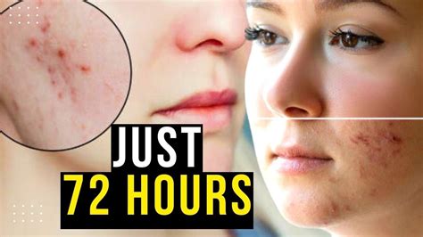 Acne Scars How To Get Rid Of Acne Scars And Spots In Hours Get Rid