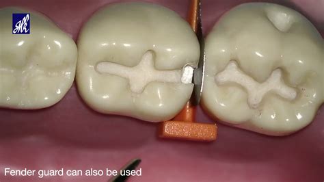 Class Ii Cavity Preparation For Amalgam Mandibular Molar Off