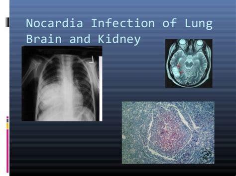 Nocardia