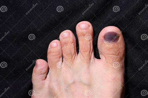 Bruise On The Big Toe Nail Stock Image Image Of Foot 290892213