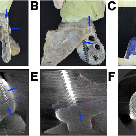 A Femur Defect Reconstructed By A Three Dimensional 3d Printed Porous