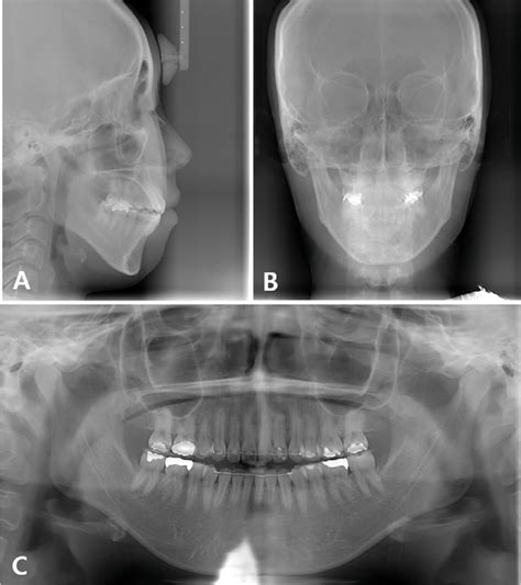 Pretreatment Radiographs A Lateral Cephalogram B Posteroanterior