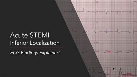 Inferior Stemi