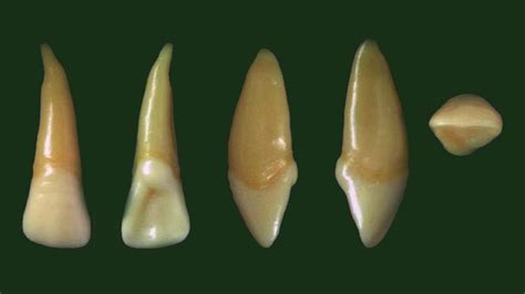 Maxillary Lateral Incisor Anatomy