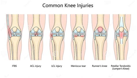 Common Knee Injuries Diagram Medical Science Stock Vector ...