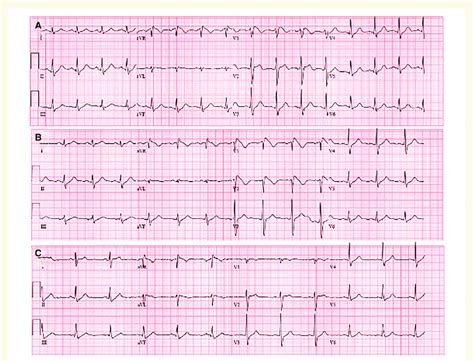 A Sinus Tachycardia With Type 1 Brugada Pattern In Right Precordial