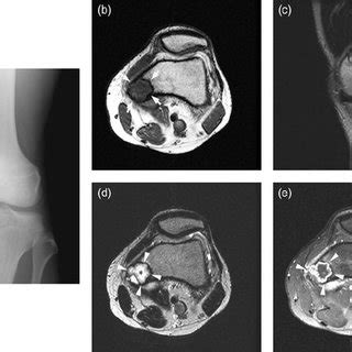 (PDF) MRI of chondromyxoid fibroma