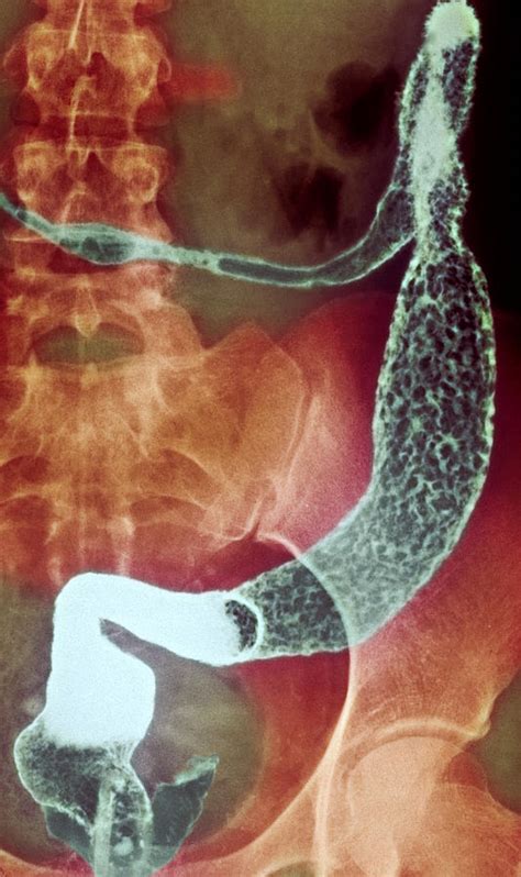 Inflamed Colon And Rectum X Ray Photograph By Cnri Fine Art America