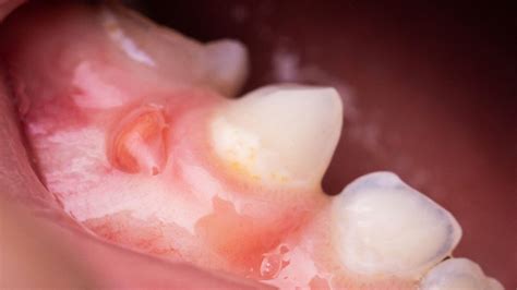 Swollen Gum Around One Tooth Symptoms Causes Treatment