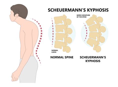 Scheuermannova Choroba Příčiny Příznaky A Léčba Spoušťovýbod