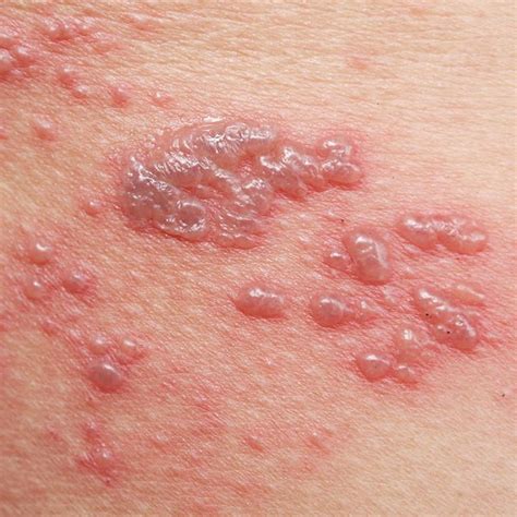 What S That Rash On Your Body Common Types Explained Types Of