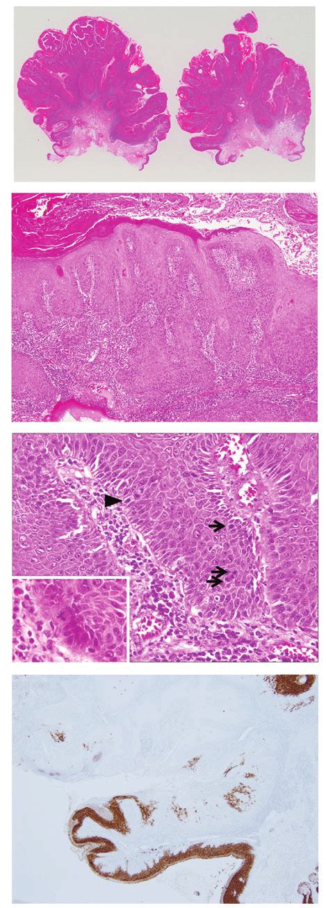 Pathological Findings A C Hematoxylin And Eosin Staining Revealing A