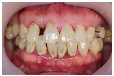 Chronic Periodontitis Focus Dentistry