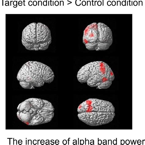 Statistical Parametric Map Of The Brain Regions In Which Alpha Band