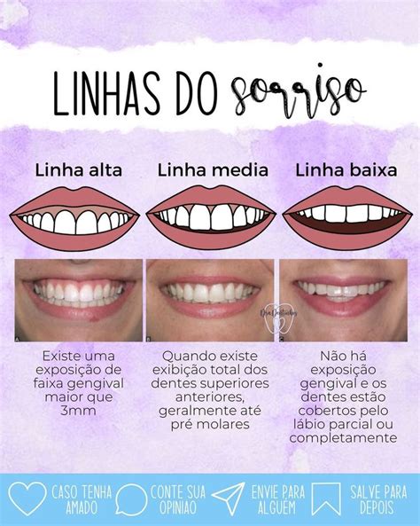 Dra Dentinhos On Instagram Linhas Do Sorriso Linha Alta O