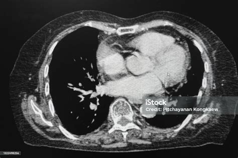 Ct Scan Organ Dada Foto Stok Unduh Gambar Sekarang Cat Scan Mesin