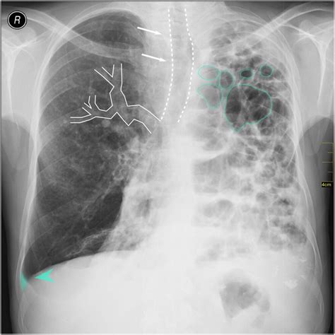 Copd Chest X Ray Frequency