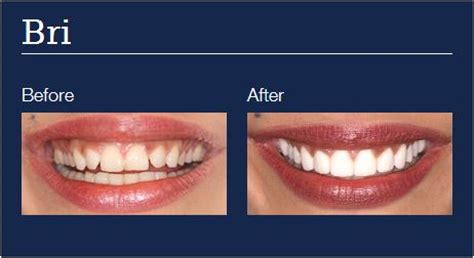 Dental Veneers and Lumineers - Summit Dental Elgin Illinois