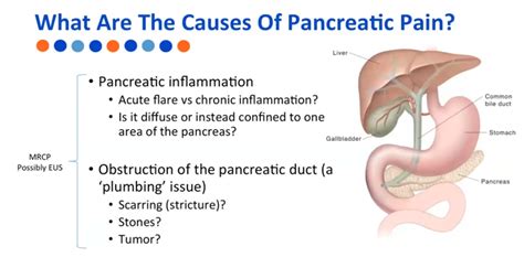 Webinar: Pancreatitis Pain: A Medical Approach with a Patient Focus ...