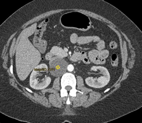 Schwannoma In The Right Para Aortic Region Gastrointestinal Case