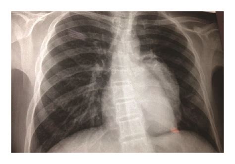 Front View Chest X Ray Showing A Rounded Prominence Of The Left Cardiac Download Scientific