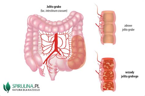 Wrzody Jelita Grubego Algi Spirulina I Chlorella