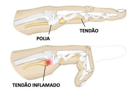 Dedo Em Gatilho Ds Ortopedia