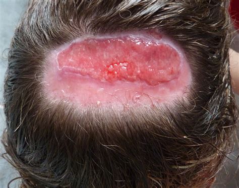 scalp injury hairdresser injury support  information