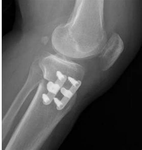 The Complications Of High Tibial Osteotomy Bone Joint