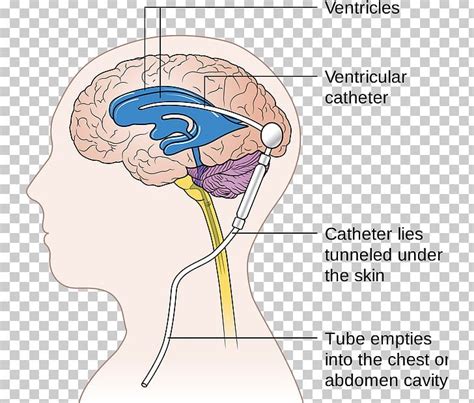 Cerebral Shunt Neurosurgery Hydrocephalus Cerebrospinal Fluid PNG ...