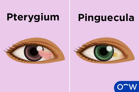 Pterygium Surfers Eye Causes Symptoms And Treatments