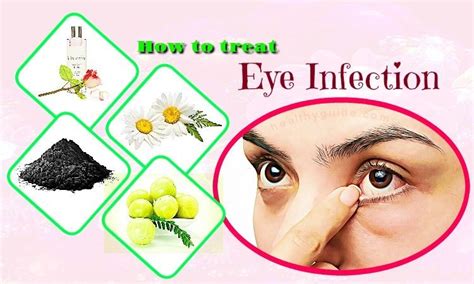 Top 33 Tips How To Treat Eye Infection Naturally At Home