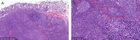 Frontiers Human Papillomavirus Associated Lymphoepithelioma Like