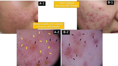 Comparison Of Clinical And Dermoscopy Findings In Rosacea And Acne