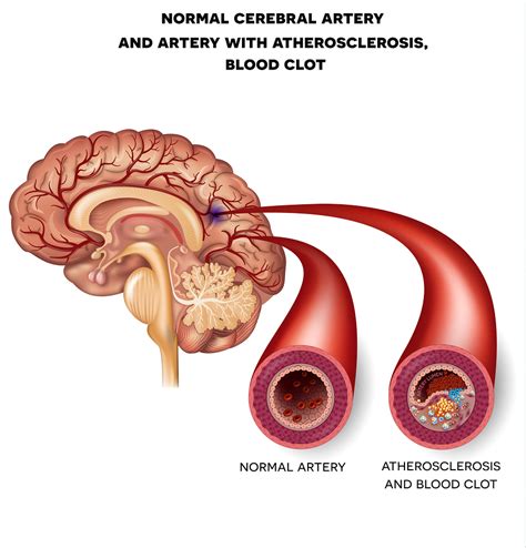 Cerebral Arteries Diagram