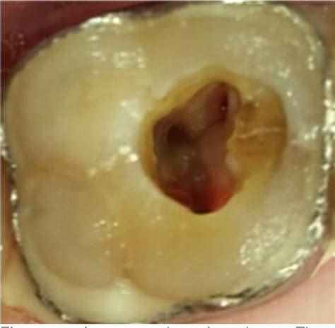 [pdf] Diagnosis And Management Of Maxillary Left Second Molar With Cracked Tooth Syndrome A