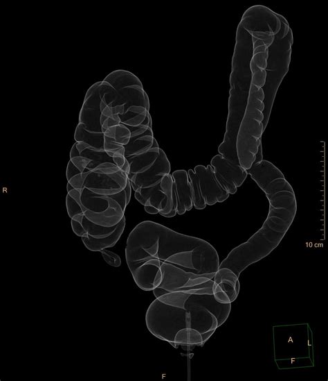 Ulcerative Colitis Image Radiopaedia Org