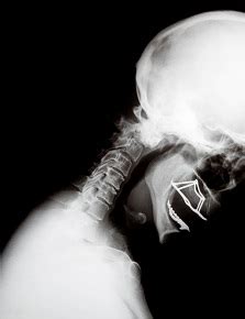 Cervical Kyphosis | Looks like the letter "C" | Opening to the front