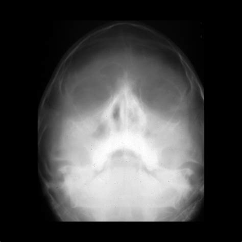 Pediatric Sinusitis Pediatric Radiology Reference Article Pediatric