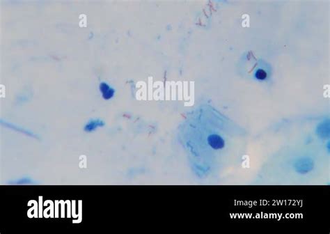 mycobacterium tuberculosis bacteria in human sputum under microscope ...