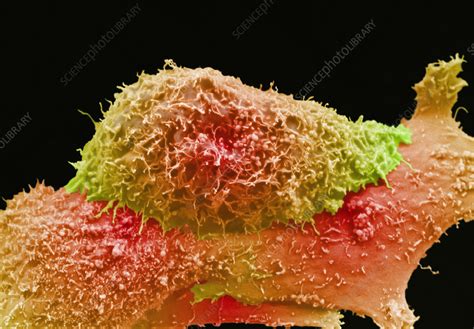 Prostate Cancer Cells Sem Stock Image C Science Photo