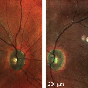 Multicolor SLO: (OD) optic nerve pallor, intraretinal hemorrhages ...