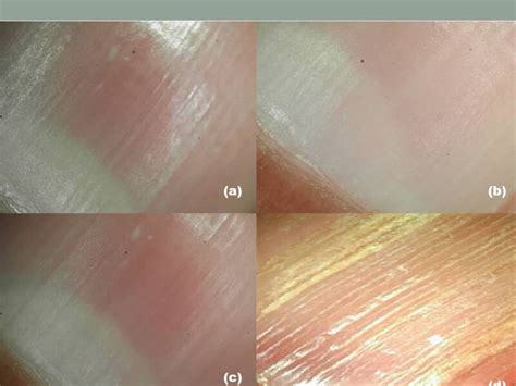 Figure Figure 2 A The Nail Statpearls Ncbi Bookshelf