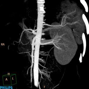 Renal Angiography Precision Scan