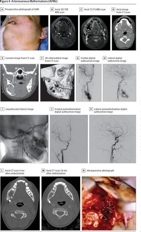 Figure 1 From Contemporary Management Of Vascular Anomalies Of The Head